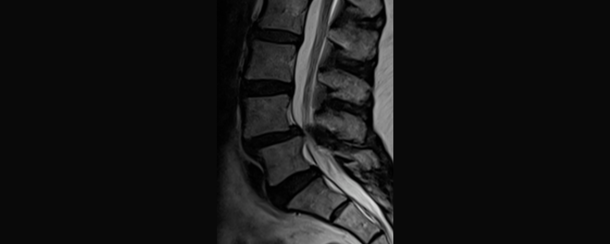Bel Kayması Nedir? Bel Kayması Belirtileri ve Tedavisi
