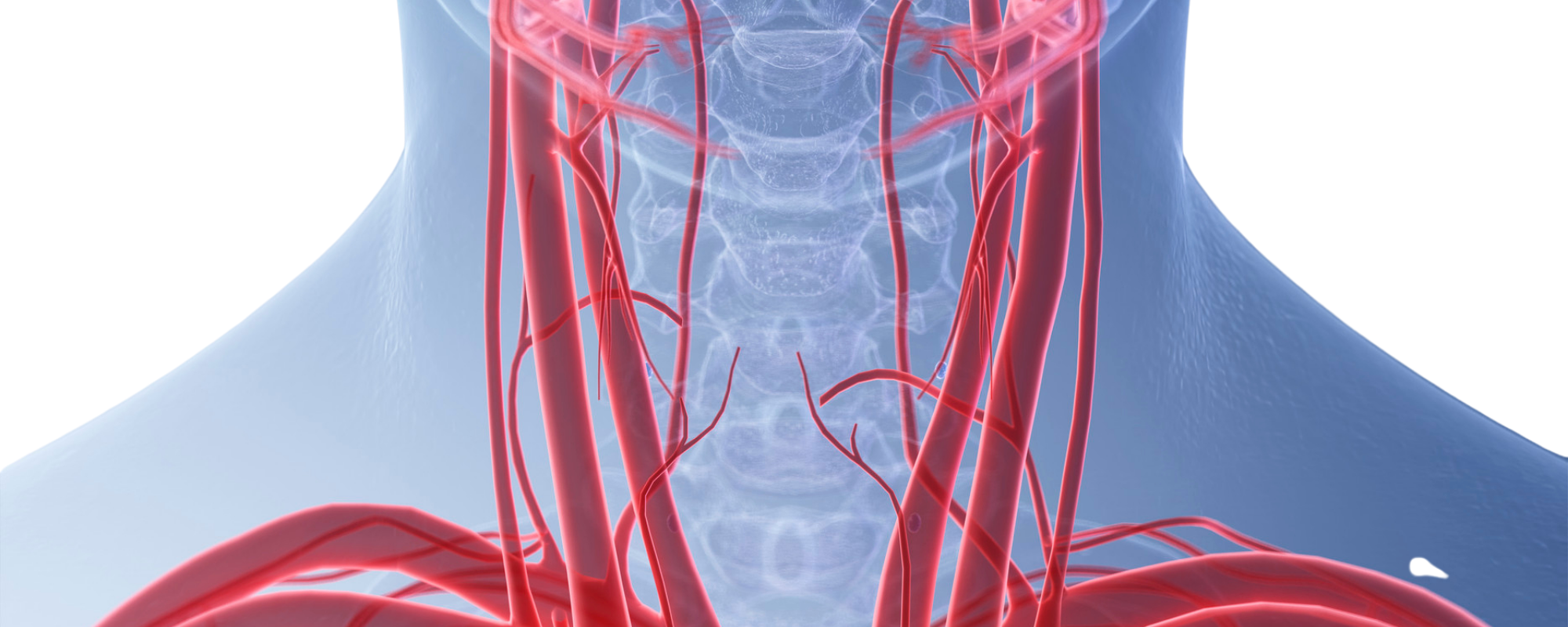 Karotis Stenozu Nedir? Belirtileri Nelerdir?