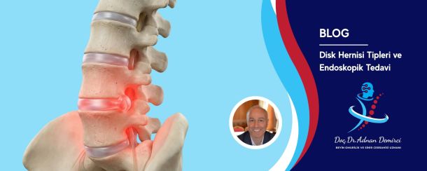 Fıtık Tipleri ve Endoskopik Tedavi