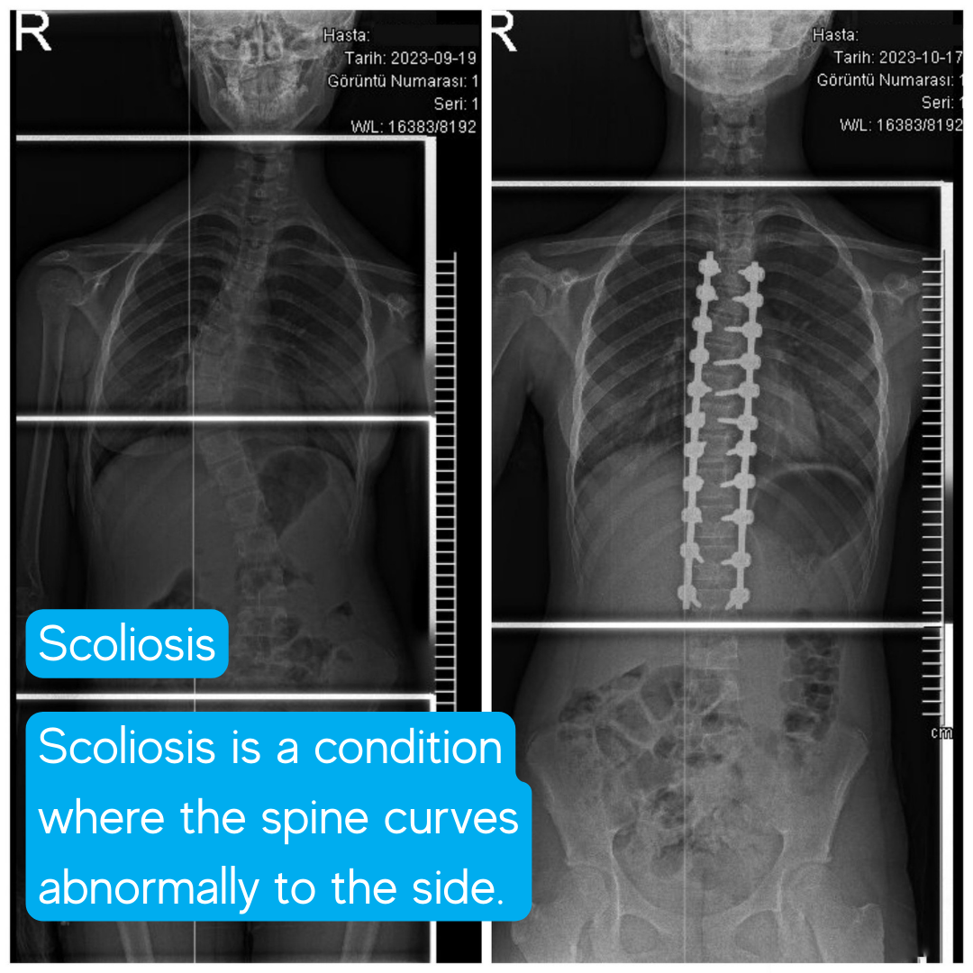 Scoliosis