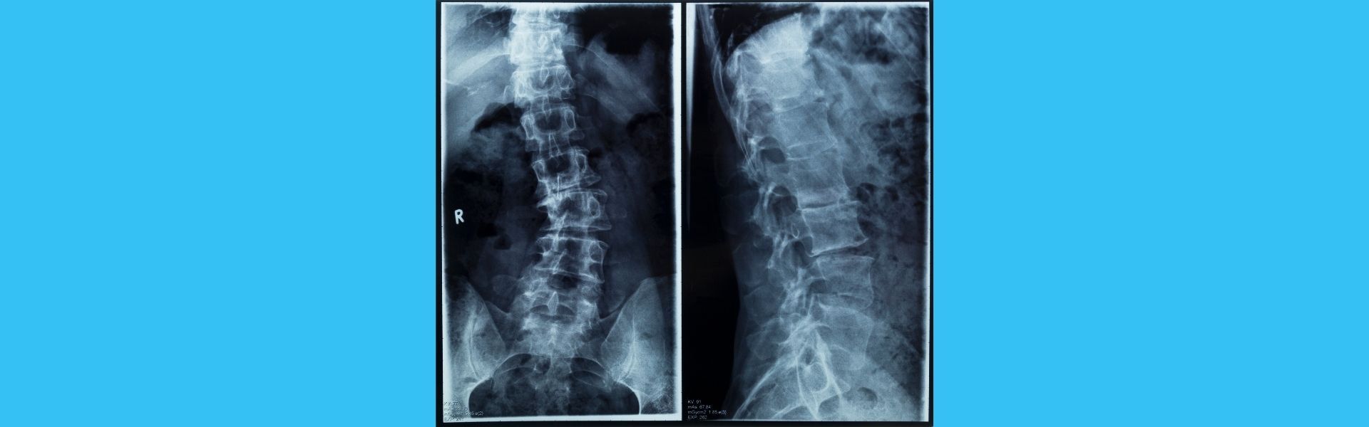 Scoliosis