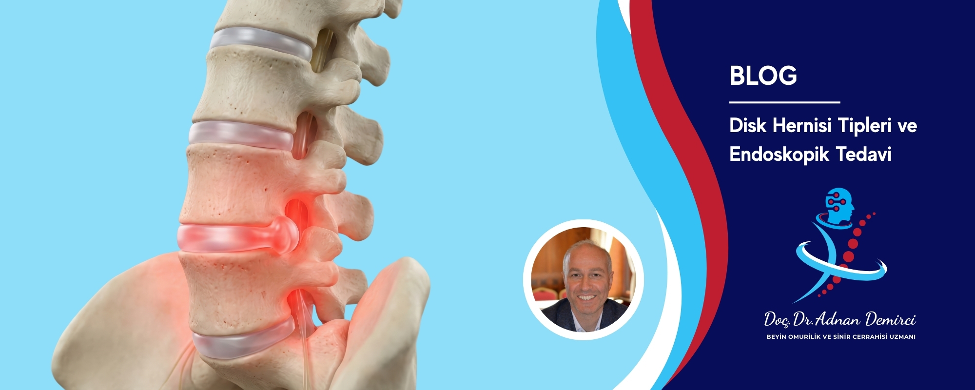 Disk Hernisi Tipleri ve Endoskopik Tedavi